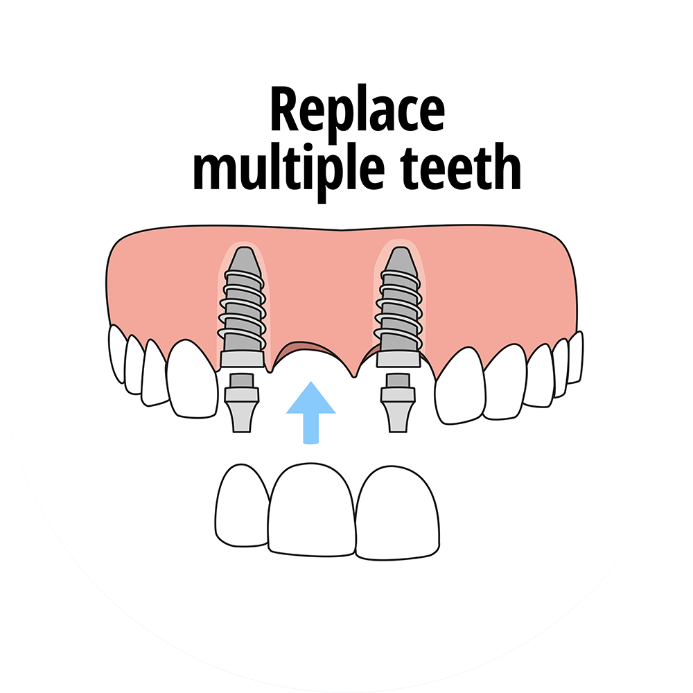 multiple tooth implant 